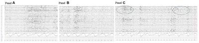 Case report: Childhood epilepsy and borderline intellectual functioning hiding an AADC deficiency disorder associated with compound heterozygous DDC gene pathogenic variants